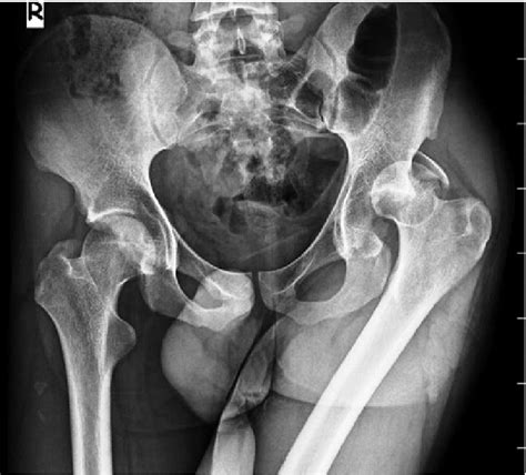 Left Hip Traumatic Fracture Dislocation Anterioposterio View