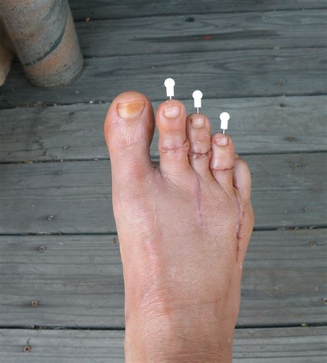 Pinned Foot Wellness Ally