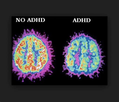 The First Pillar Of Adhd An Interest Based Nervous System The Adhd