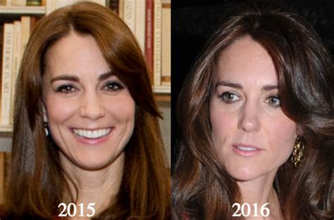 Kate Middleton Plastic Surgery Rumors Now And Then Pictures