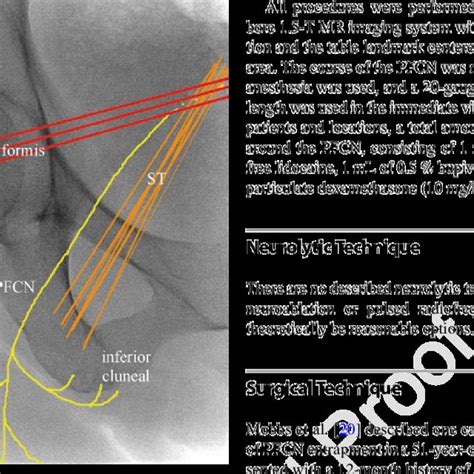 Lateral Femoral Cutaneous Nerve Injury