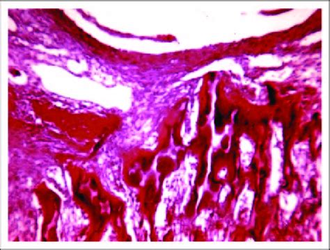 Classic Gross Appearance Of An Aneurysmal Bone Cyst Of A Rib The