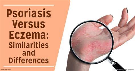 Psoriasis Versus Eczema Whats The Difference