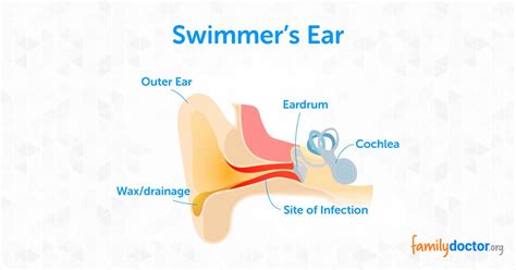 Otitis Externa What To Do For Swimmers Ear