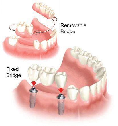 This type of coverage cannot impose an annual benefit maximum by law, making it the ideal option. Guarded Dental Bridge Maryland #oralcareph #DentalBridgeCostFractions # ...
