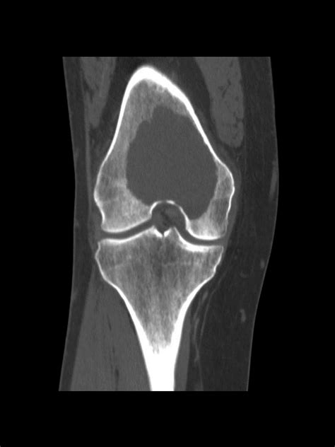 Giant Cell Tumor Of Bone Wikidoc