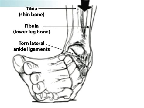 Ankle Sprains And Physical Therapy Interventions — Mend