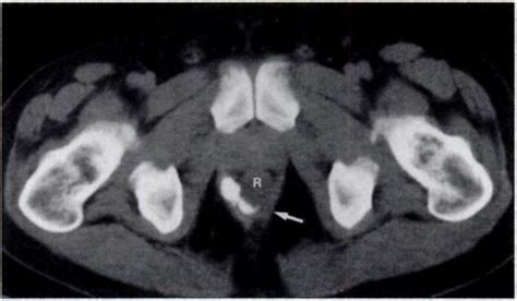 Fistulas And Sinus Tracts In Three Patients A Ct Scan Shows Abscess