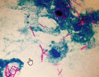 Mycobacterium Tuberculosis Gram Stain