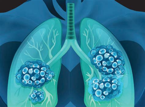 Lung Nodule Montgomery Pulmonary Consultants