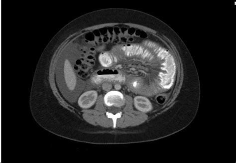 Cureus Abdominal Pain And Ascites Not Always Related To Portal