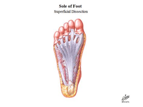 Plantar Fascia Rupture Soniferous Solutions