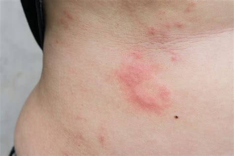 How To Get Rid Of Hives With Home Remedies Fab How