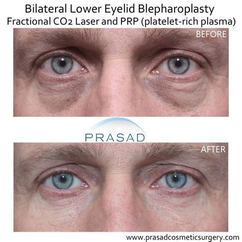 Under Eye Wrinkle Treatment Options Dr Prasad Blog