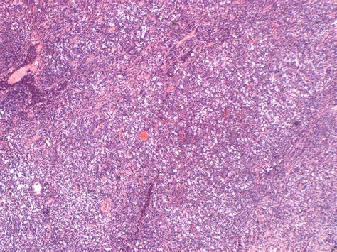 Hodgkins Like Lymphoma In A Cat Case Study Cytopath