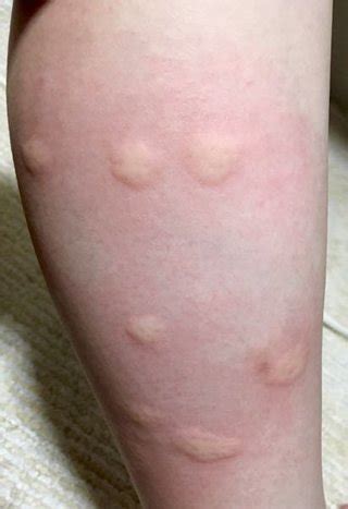 Maybe you would like to learn more about one of these? 虫 刺され 跡 | 虫刺され跡を消す方法とかゆみの対処、市販薬 ...