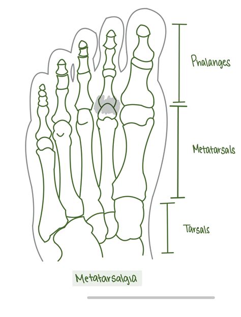 Forefoot Pain Metatarsalgia The Rehab Centre