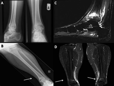 Tibial Insufficiency Fractures In Rheumatoid Arthritis A New Clinical