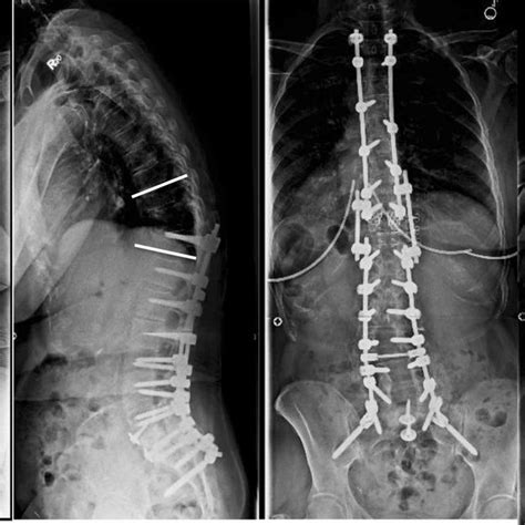 A 69 Year Old Woman Underwent Posterior Spinal Fusion From T2 To T12 Download Scientific