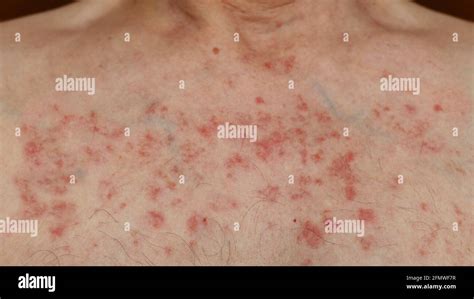 Skin Reaction On A Man Chest After Chemotherapy Allergic Reaction
