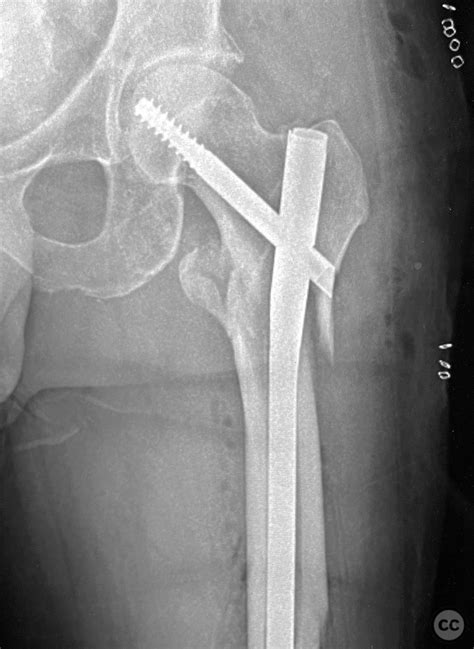 Inter Subtrochanteric Femur Fracture With Clamshell Fragment