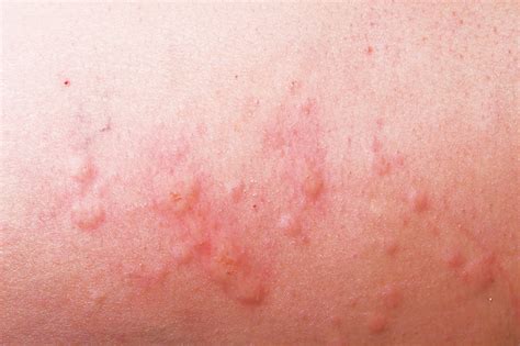 Identifying Skin Rashes In Children Images And Photos Finder
