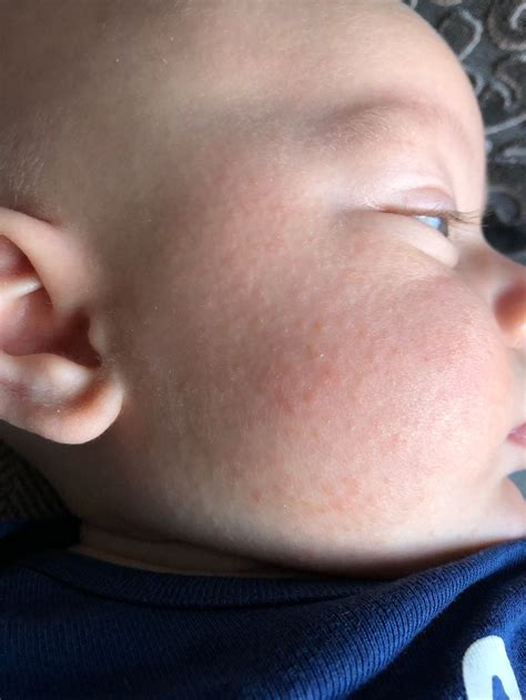 Baby Drool Rash Or Eczema Talia Garris