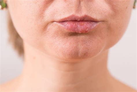 What Causes White Bumps On Lips And How To Treat It