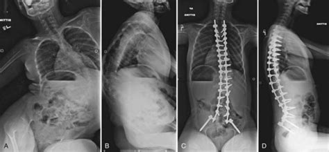 Neuromuscular Scoliosis Clinical Gate