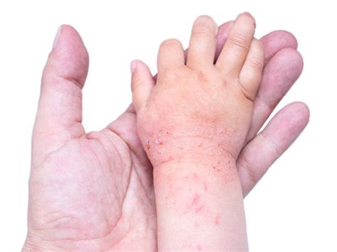 Dermatite Atopica Nei Bambini Cause Sintomi E Cure Dermatologia Prati