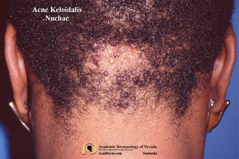 Acne Keloidalis Nuchae AKN Folliculitis Keloidalis Academic Dermatology Of Nevada