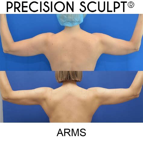 Precision Sculpt®️ Arms Before And 3 Months After This Procedure Is