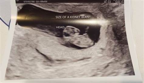 Any 8 9 Week Ultrasounds Babycenter