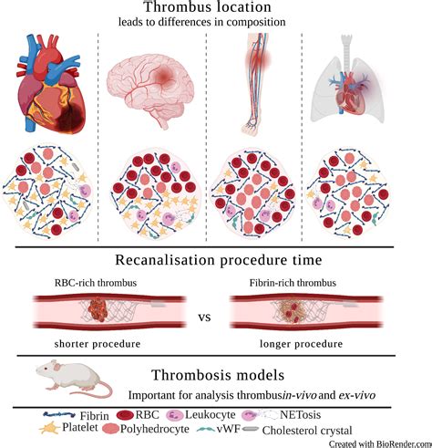 Thrombus Structural Composition In Cardiovascular Disease