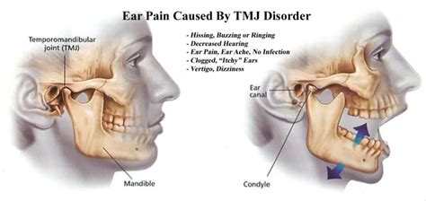 Ear Pain And Ringing Head Pain Institute