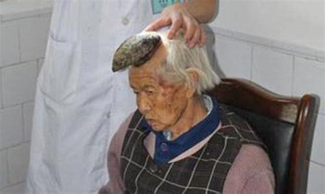 Meet The 87 Year Old Woman Who Has A Five Inch Horn Growing Out Of Her