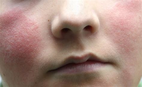 Czerwone policzki Pozbądź się zaczerwienień na twarzy Clinica Cosmetologica dr Igor