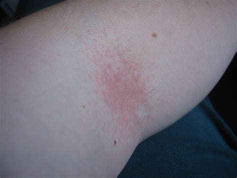 Rash On Inside Of Elbow Pictures Photos