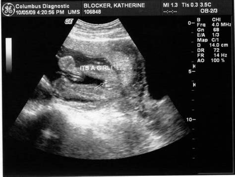 What To Expect With Ultrasound Done At 19th Week Of Pregnant With