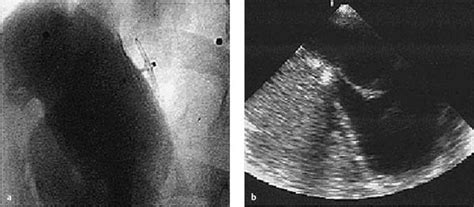 Occlusion Of Septal Defects Thoracic Key