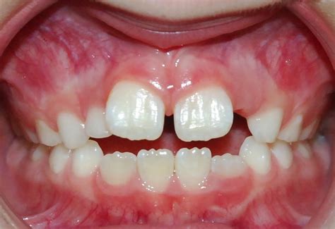 Diastemas Dentales Qué Son Y Cómo Corregirlos