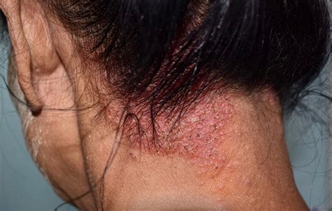 All You Need To Know About Seborrheic Dermatitis