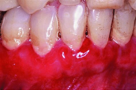Localized Blister Formation On The Gingiva Associated With Mucous