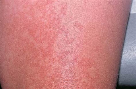 Fifth Disease Rash Pictures Pictures Photos