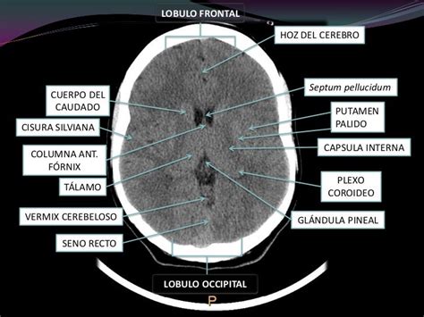 Interpretacion De Anatomia Cerebral En Una Tac Craneal