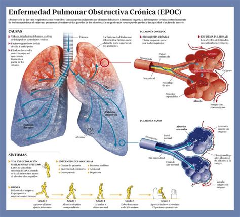 Infograf A Explicativa De La Enfermedad Pulmonar Obstructiva Cr Nica Epoc Enfermedad