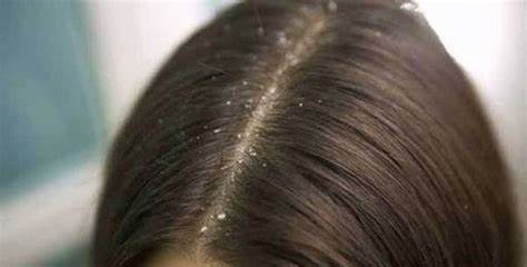 Wet Dandruff - What Is It And How To Treat It?