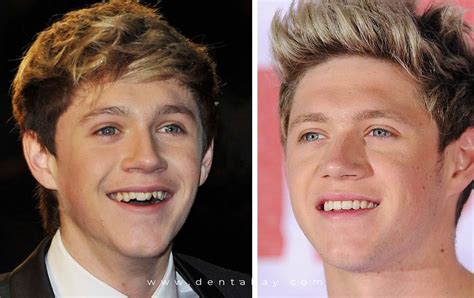 6 Shocking Celebrity Veneers With Before And After Pictures