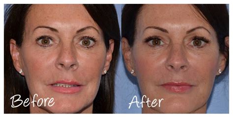 Non Surgical Facelift Training Advanced Dermal Filler Training Cosmetic Courses