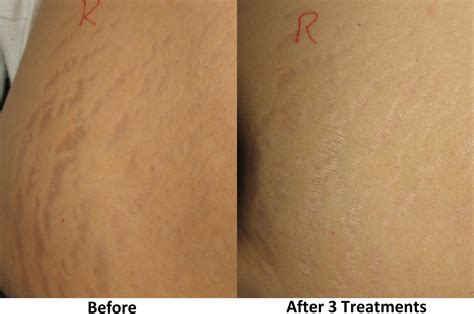 Scar And Stretch Mark Treatments Rhett Womens Centerrhett Womens